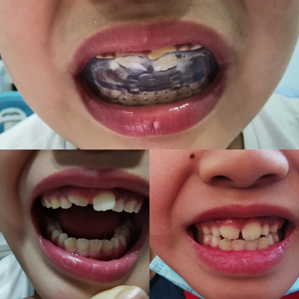 儿童牙齿矫正器隐形牙套矫形龅牙地包天保持器防夜间磨牙反颌 - 皓